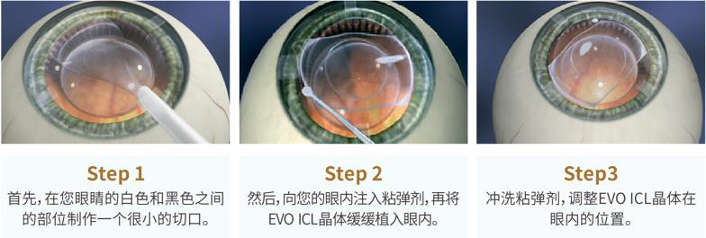 屈光矯視,希瑪瑞視眼科,上海眼科醫院 屈光矯視,希瑪瑞視眼科,上海眼科醫院