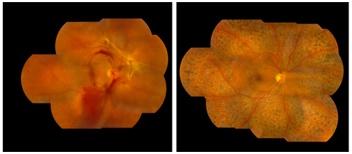 青光眼,希瑪瑞視眼科,上海眼科醫院 青光眼,希瑪瑞視眼科,上海眼科醫院