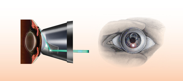 青光眼,希瑪瑞視眼科,上海眼科醫院 青光眼,希瑪瑞視眼科,上海眼科醫院