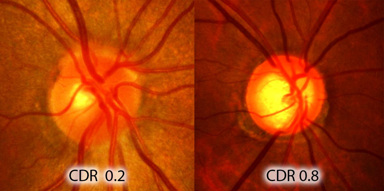青光眼,希瑪瑞視眼科,上海眼科醫院