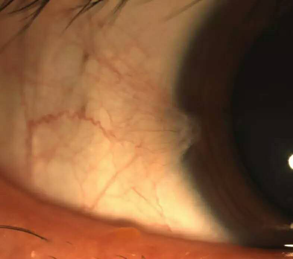 眼表眼角膜,希瑪瑞視眼科,上海眼科醫院 眼表眼角膜,希瑪瑞視眼科,上海眼科醫院