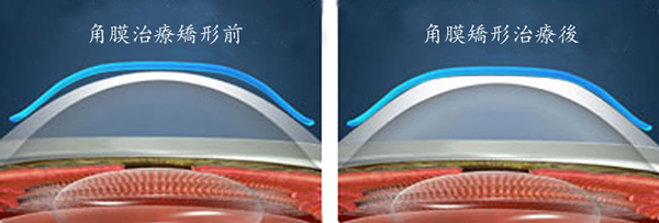 屈光矯視,希瑪瑞視眼科,上海眼科醫院