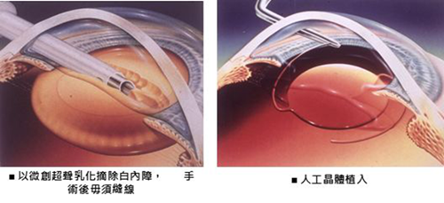 白內障,?，斎鹨曆劭?上海眼科醫院