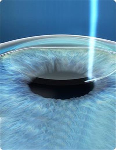 屈光矯視,?，斎鹨曆劭?上海眼科醫(yī)院