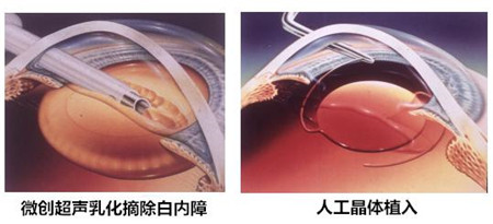 白內障,?，斎鹨曆劭?上海眼科醫院