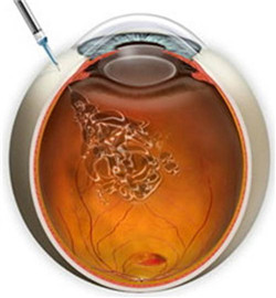 玻璃體視網膜,希瑪瑞視眼科,上海眼科醫院 玻璃體視網膜,希瑪瑞視眼科,上海眼科醫院