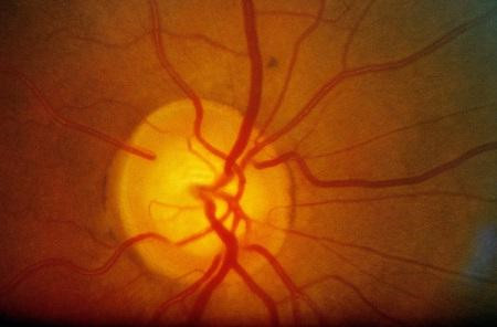 青光眼,希瑪瑞視眼科,上海眼科醫院