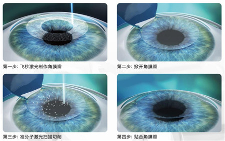 屈光矯視,希瑪瑞視眼科,上海眼科醫院 屈光矯視,希瑪瑞視眼科,上海眼科醫院