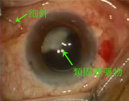 白內(nèi)障,希瑪瑞視眼科,上海眼科醫(yī)院 白內(nèi)障,希瑪瑞視眼科,上海眼科醫(yī)院
