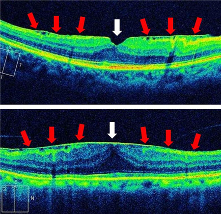 玻璃體視網(wǎng)膜,希瑪瑞視眼科,上海眼科醫(yī)院 玻璃體視網(wǎng)膜,希瑪瑞視眼科,上海眼科醫(yī)院