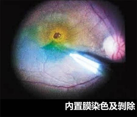 玻璃體視網(wǎng)膜,希瑪瑞視眼科,上海眼科醫(yī)院 玻璃體視網(wǎng)膜,希瑪瑞視眼科,上海眼科醫(yī)院