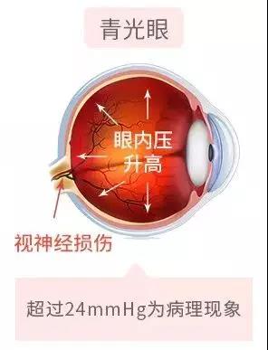 青光眼,希瑪瑞視眼科,上海眼科醫院