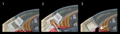 青光眼,希瑪瑞視眼科,上海眼科醫院 青光眼,希瑪瑞視眼科,上海眼科醫院