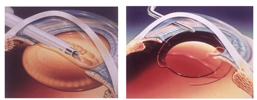 青光眼,希瑪瑞視眼科,上海眼科醫(yī)院