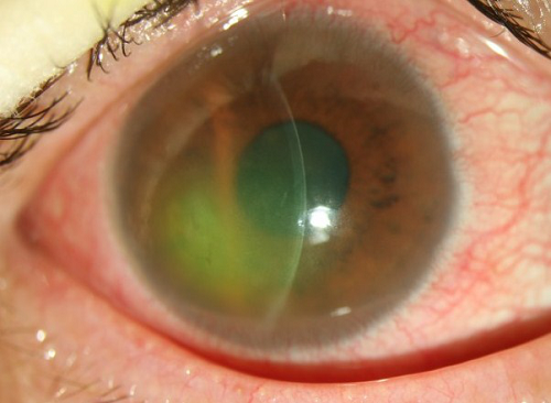 眼表眼角膜,?，斎鹨曆劭?上海眼科醫(yī)院