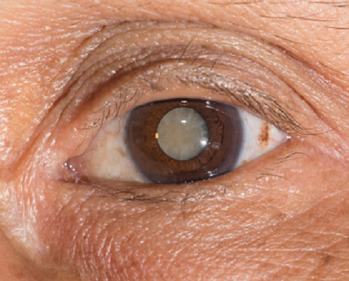 眼表眼角膜,?，斎鹨曆劭?上海眼科醫(yī)院