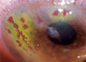 眼表眼角膜,希瑪瑞視眼科,上海眼科醫(yī)院 眼表眼角膜,希瑪瑞視眼科,上海眼科醫(yī)院