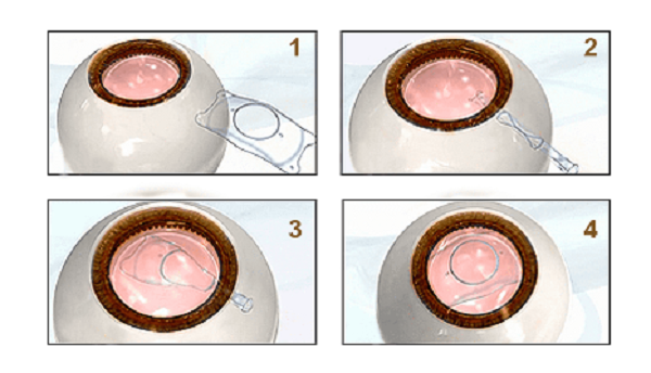 屈光矯視,希瑪瑞視眼科,上海眼科醫院 屈光矯視,希瑪瑞視眼科,上海眼科醫院