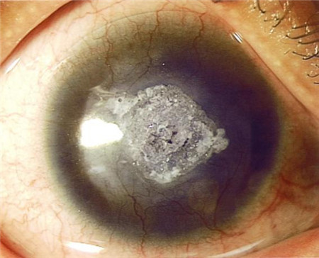 眼表眼角膜,希瑪瑞視眼科,上海眼科醫(yī)院 眼表眼角膜,希瑪瑞視眼科,上海眼科醫(yī)院