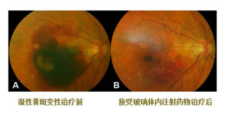 玻璃體視網(wǎng)膜,希瑪瑞視眼科,上海眼科醫(yī)院