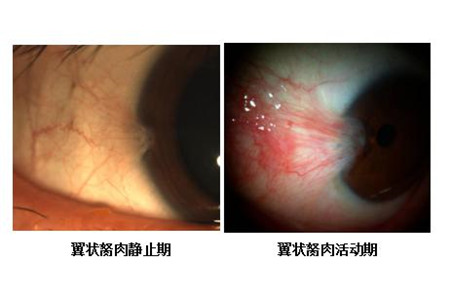 眼表眼角膜,希瑪瑞視眼科,上海眼科醫(yī)院 眼表眼角膜,希瑪瑞視眼科,上海眼科醫(yī)院