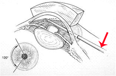 青光眼,希瑪瑞視眼科,上海眼科醫(yī)院