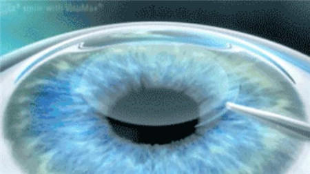 屈光矯視,希瑪瑞視眼科,上海眼科醫(yī)院 屈光矯視,希瑪瑞視眼科,上海眼科醫(yī)院