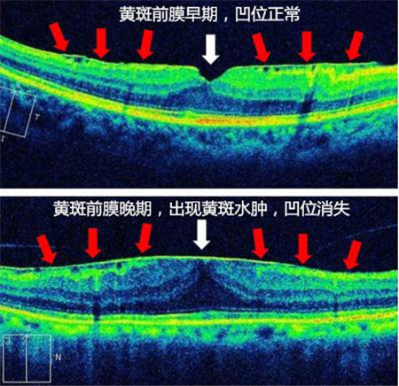 玻璃體視網膜,希瑪瑞視眼科,上海眼科醫院 玻璃體視網膜,希瑪瑞視眼科,上海眼科醫院