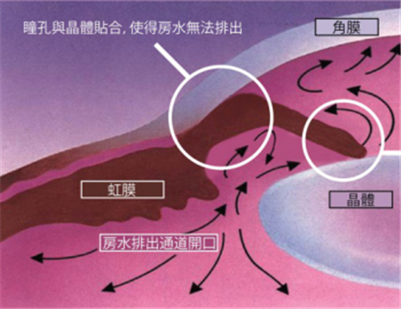 青光眼,希瑪瑞視眼科,上海眼科醫院
