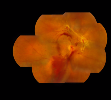 玻璃體視網膜,希瑪瑞視眼科,上海眼科醫院