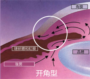 青光眼,希瑪瑞視眼科,上海眼科醫院 青光眼,希瑪瑞視眼科,上海眼科醫院