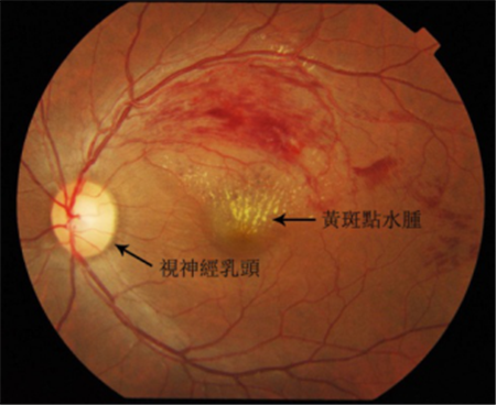 玻璃體視網(wǎng)膜,希瑪瑞視眼科,上海眼科醫(yī)院