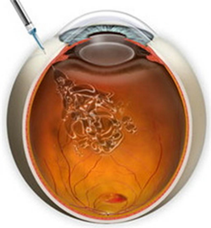 玻璃體視網(wǎng)膜,希瑪瑞視眼科,上海眼科醫(yī)院