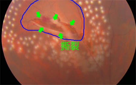 玻璃體視網膜,希瑪瑞視眼科,上海眼科醫院 玻璃體視網膜,希瑪瑞視眼科,上海眼科醫院