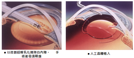 白內障,希瑪瑞視眼科,上海眼科醫院