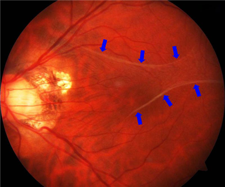 玻璃體視網(wǎng)膜,?，斎鹨曆劭?上海眼科醫(yī)院