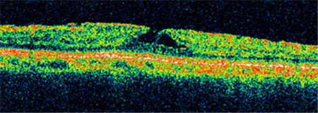 玻璃體視網膜,希瑪瑞視眼科,上海眼科醫院
