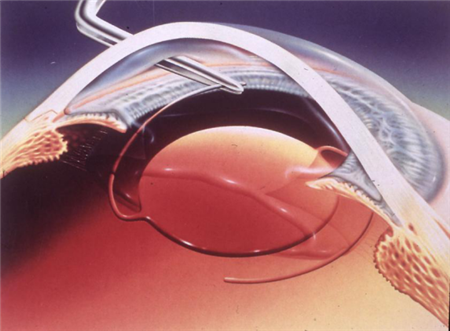 白內障,?，斎鹨曆劭?上海眼科醫院