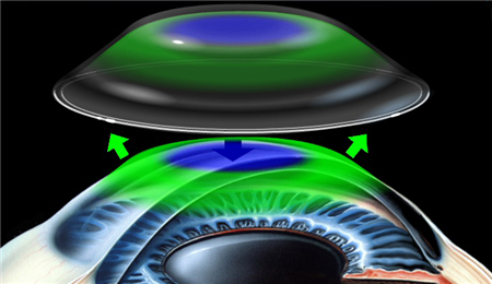 小兒眼病,希瑪瑞視眼科,上海眼科醫院