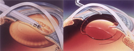 白內(nèi)障,?，斎鹨曆劭?上海眼科醫(yī)院