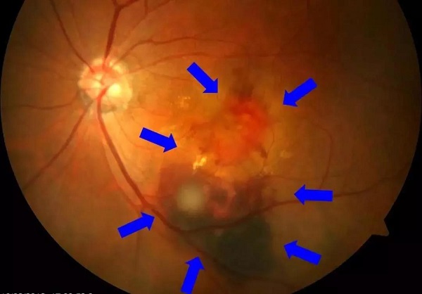 玻璃體視網(wǎng)膜,希瑪瑞視眼科,上海眼科醫(yī)院 玻璃體視網(wǎng)膜,希瑪瑞視眼科,上海眼科醫(yī)院