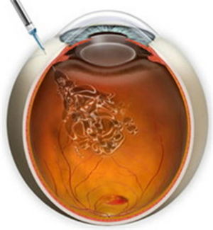 玻璃體視網膜,希瑪瑞視眼科,上海眼科醫院 玻璃體視網膜,希瑪瑞視眼科,上海眼科醫院