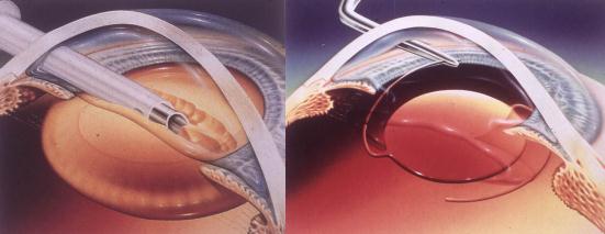 白內障,希瑪瑞視眼科,上海眼科醫院 白內障,希瑪瑞視眼科,上海眼科醫院