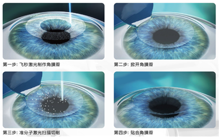 屈光矯視,希瑪瑞視眼科,上海眼科醫院 屈光矯視,希瑪瑞視眼科,上海眼科醫院