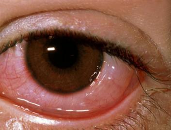 眼表眼角膜,希瑪瑞視眼科,上海眼科醫院