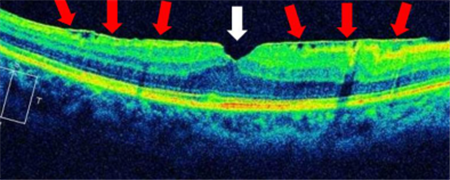 玻璃體視網(wǎng)膜,希瑪瑞視眼科,上海眼科醫(yī)院 玻璃體視網(wǎng)膜,希瑪瑞視眼科,上海眼科醫(yī)院
