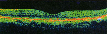 玻璃體視網膜,希瑪瑞視眼科,上海眼科醫院 玻璃體視網膜,希瑪瑞視眼科,上海眼科醫院