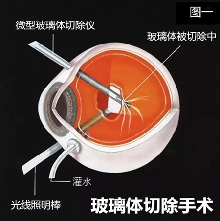 玻璃體視網膜,希瑪瑞視眼科,上海眼科醫院 玻璃體視網膜,希瑪瑞視眼科,上海眼科醫院