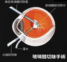 玻璃體視網(wǎng)膜,希瑪瑞視眼科,上海眼科醫(yī)院 玻璃體視網(wǎng)膜,希瑪瑞視眼科,上海眼科醫(yī)院