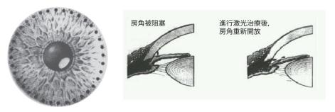 青光眼,希瑪瑞視眼科,上海眼科醫院